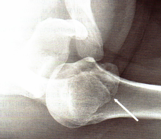 os acromial.png