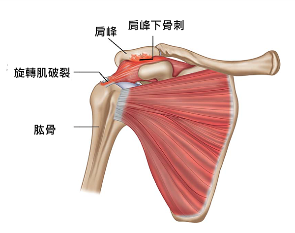 subacromial spur with RCT.png subacromial spur with RCT.png