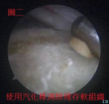 旋轉肌  清footprint.jpg 旋轉肌  清footprint.jpg