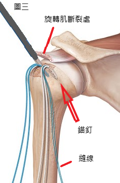 suture anchor into bone.png suture anchor into bone.png