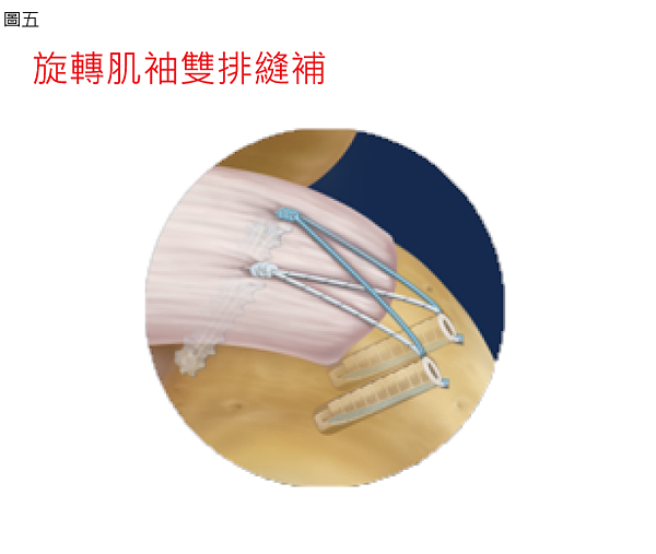 旋轉肌雙排.png 旋轉肌雙排.png