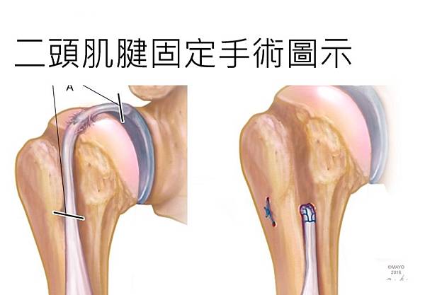 biceps-tenodesis.jpg