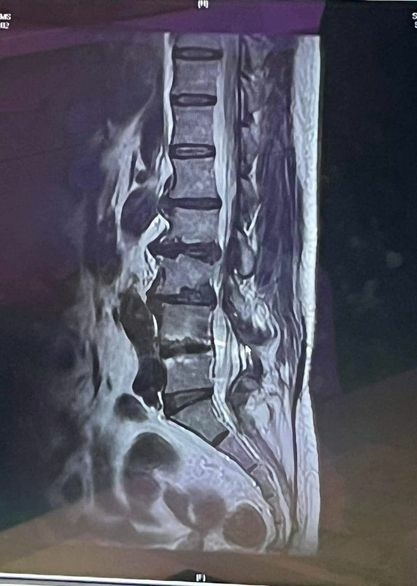 勞保可以申請理賠壓迫到神經嗎?