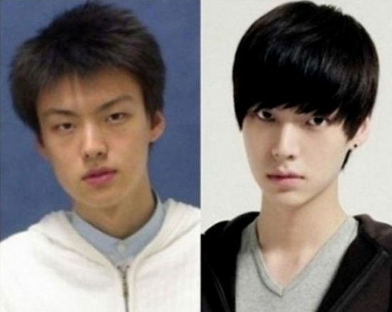 雙眼皮手術 雙眼皮手術