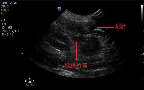 穿刺採樣.png