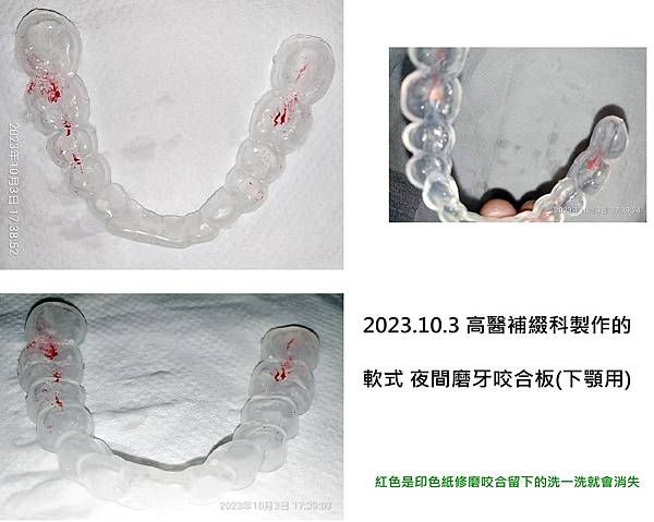 2023.10.3 磨牙咬合板.jpg