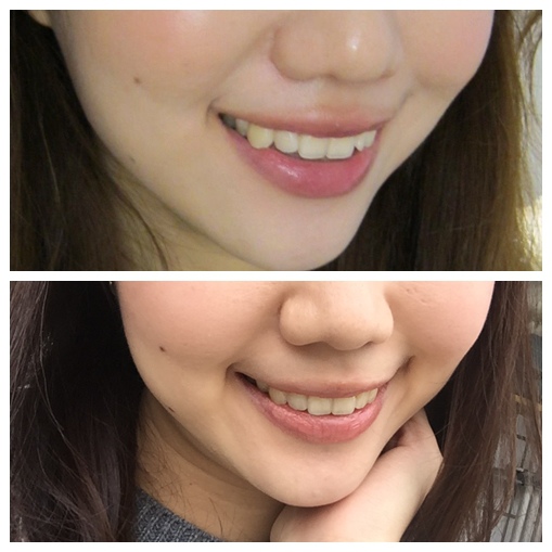 牙套 短短的11個月 拆矯正器囉 Akiko S Blog 痞客邦