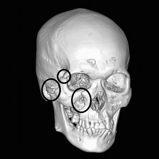 zygoma.jpg zygoma.jpg