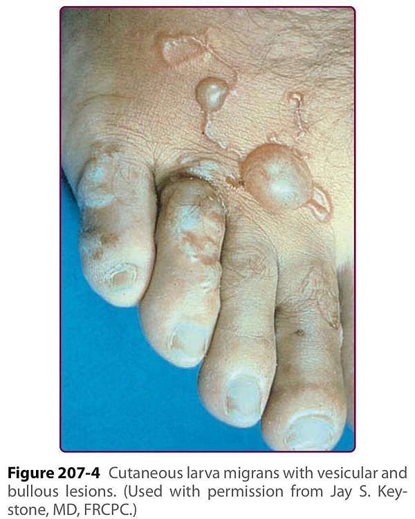 在人腿中爬行的蟲蟲 Cutaneous Larva Migrans 皮膚寄生蟲幼蟲移行症 愛力獅alex Md Plastic Surgeon 薛榮華整形外科醫師 痞客邦 在人腿中爬行的蟲蟲 Cutaneous Larva Migrans 皮膚寄生蟲幼蟲移行症 愛力獅alex Md Plastic Surgeon 薛榮華整形外科醫師 痞客邦