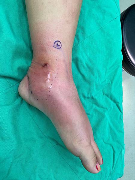 00100944 Lt lower leg abscess sp fasciotomy (1).jpg 00100944 Lt lower leg abscess sp fasciotomy (1).jpg