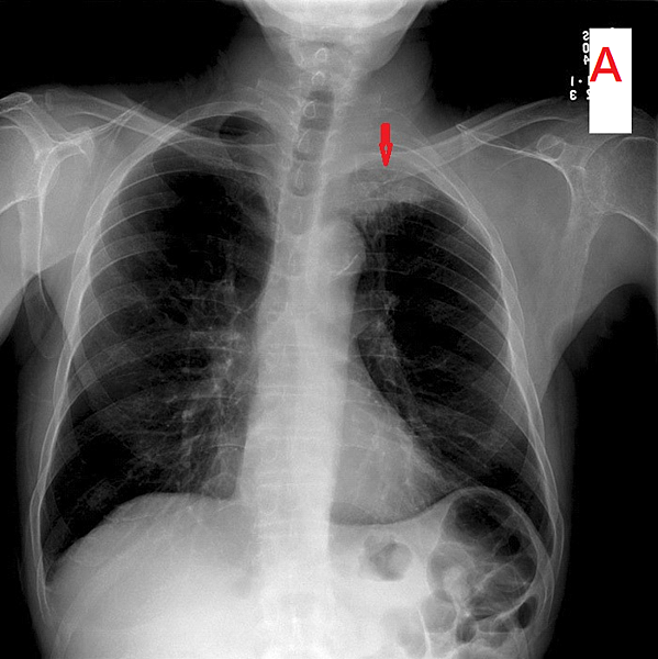 pleural thickening1