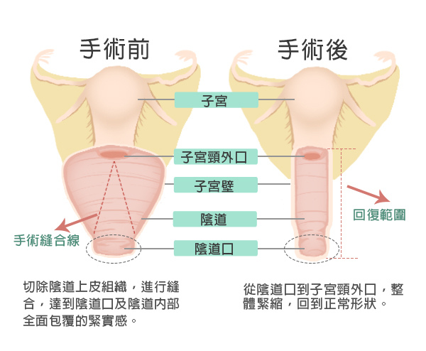 陰道緊縮術-示意圖600