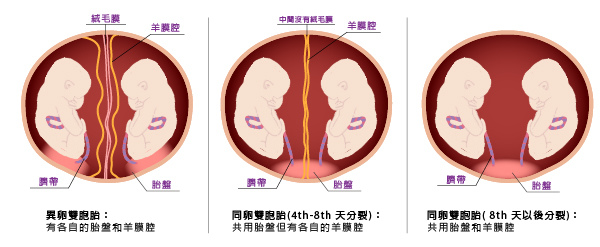 雙胞胎/多胞胎生產,同卵、異卵雙胞胎形成原因 雙胞胎/多胞胎生產,同卵、異卵雙胞胎形成原因