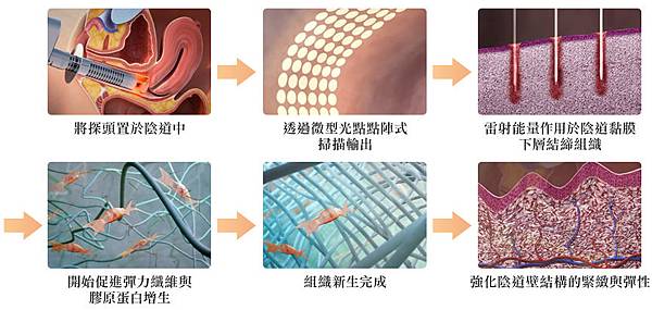 產後閨房話題：私密處不再是”濕”密處，蒙娜麗莎之吻解決更多私密處問題1