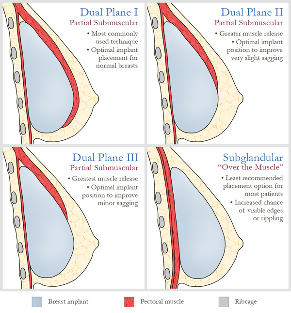 parker-breast-implant-placement-600.jpg