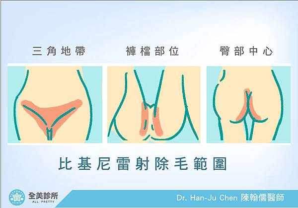 比加尼除毛部位1.jpg