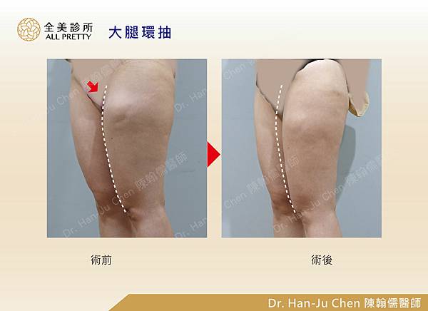 抽脂補胸+脂肪瘤-大腿抽脂-202010074.jpg 抽脂補胸+脂肪瘤-大腿抽脂-202010074.jpg