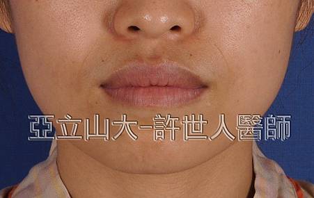 M形微笑縮唇術
