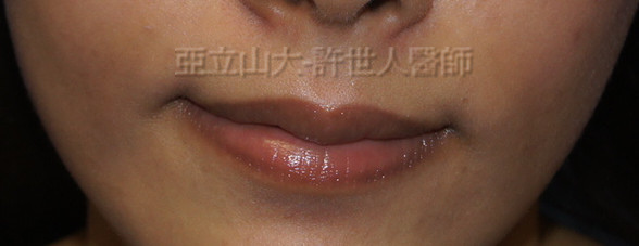 M形微笑縮唇術