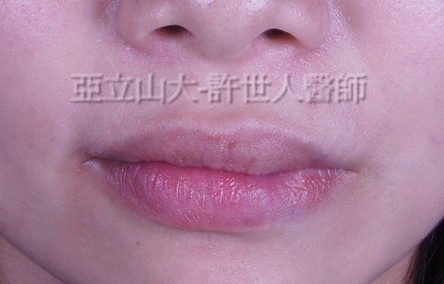 M形微笑縮唇術