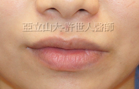 M形微笑縮唇術