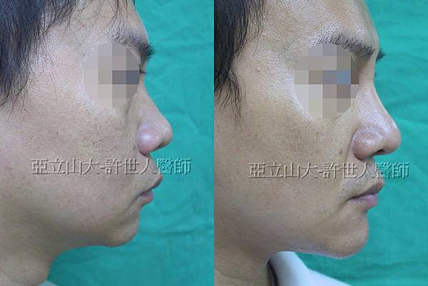 nose+chin7 nose+chin7