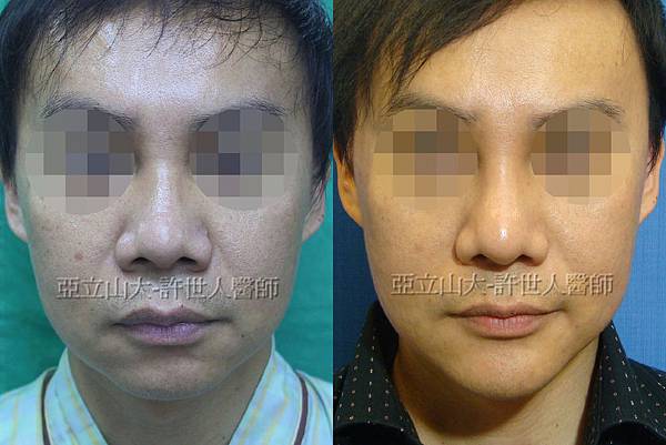 nose+chin 7-1 nose+chin 7-1