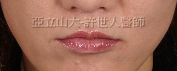 M形微笑縮唇術