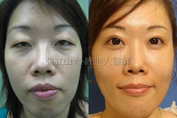 眼袋手術合併提眼瞼肌和雙眼皮手術.jpg