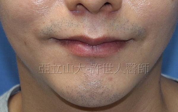 訂做來自星星的微笑man唇 男人篇 微笑嘴唇縮唇術 許你一個美麗人生 亞立山大許世人醫師的整形部落格專長 自體脂肪隆乳 微整形及全身各種新式整形手術 訂做來自星星的微笑man唇 男人篇 微笑嘴唇縮唇術 許你一個美麗人生 亞立山大許世人醫師的整形部落格專長 自體脂肪隆乳 微整形及全身各種新式整形手術