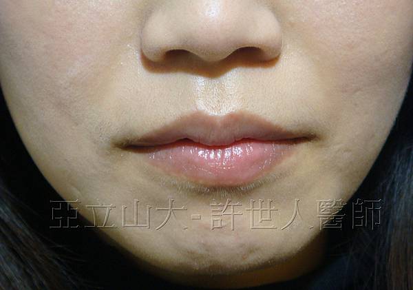 M形微笑縮唇術