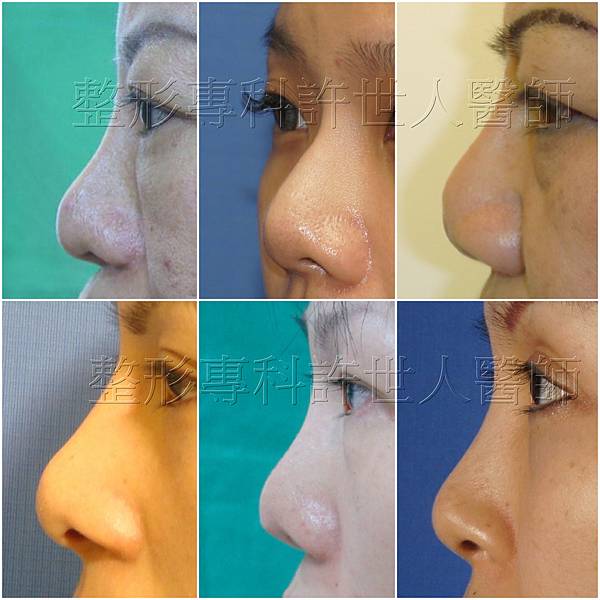 鼻頭鸚鵡嘴變形pollybeak deformity a 浮.jpg 鼻頭鸚鵡嘴變形pollybeak deformity a 浮.jpg