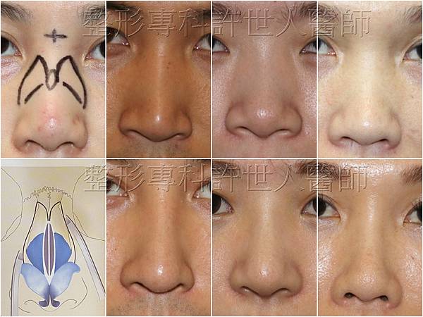 osteotomy 浮.jpg osteotomy 浮.jpg