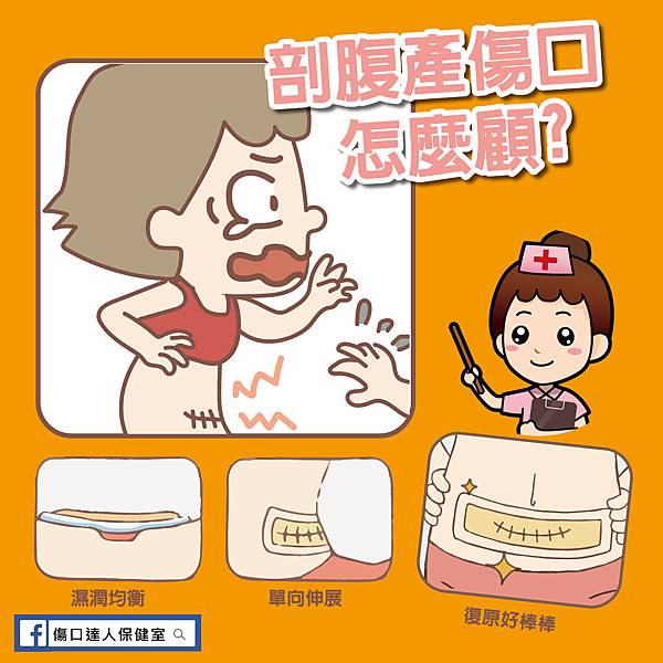 剖腹產媽咪 剖腹產媽咪