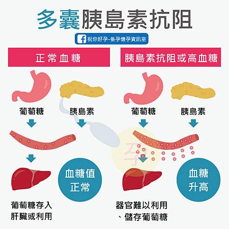 多囊肥胖不孕症 胰島素阻抗-01