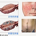 PCOS多囊性卵巢症候群症狀