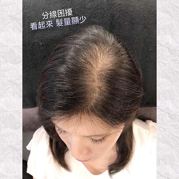 髮際線實例 頭頂髮量少vs 頭頂分線明顯該怎麼辦 美智紋繡殿 幫您創造完美髮際線 台北 高雄服務 痞客邦