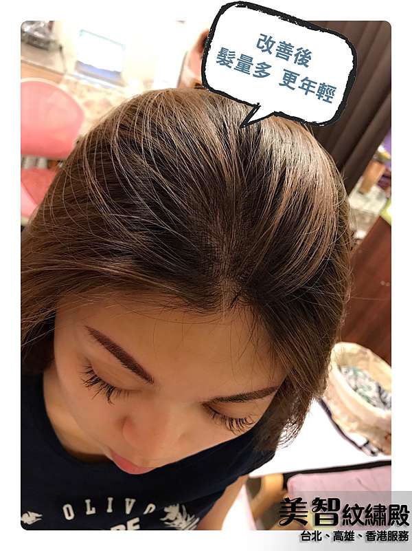 髮際線實例 頭頂髮量少vs 頭頂分線明顯該怎麼辦 美智紋繡殿 幫您創造完美髮際線 台北 高雄服務 痞客邦
