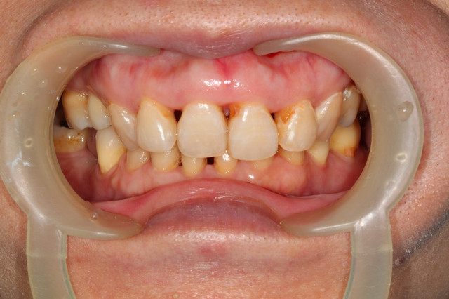 术后:处理蛀牙及脱钙,关三角缝,调整牙齿大小及作齐 制作颗数:6颗3d