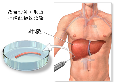 腫瘤自動消失了 是奇蹟嗎 癌症的確診與切片 Andante的癌症科普教室 痞客邦