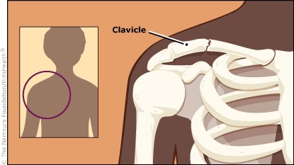 Clavicular fracture