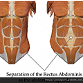 diastasis_recti-300x232