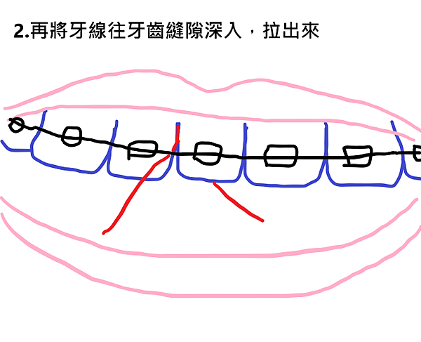 牙套日記、牙齒矯正