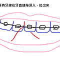 牙套日記、牙齒矯正