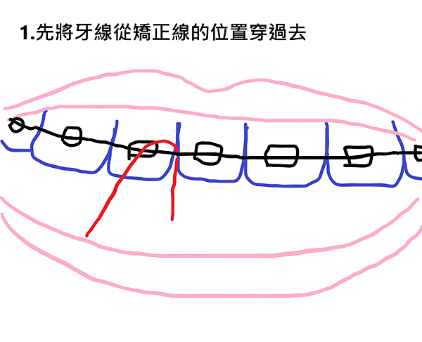 牙套日記、牙齒矯正