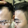 Annlala Beauty 男士髮際線