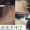 Annlala Beauty 外泌體操作前後 (1).PNG