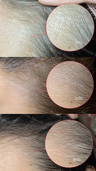 Annlala Beauty 外泌體實做 BA (3).JPG Annlala Beauty 外泌體實做 BA (3).JPG