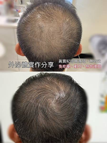 Annlala Beauty 外泌體 從落髮第七期到第二期.jpg Annlala Beauty 外泌體 從落髮第七期到第二期.jpg