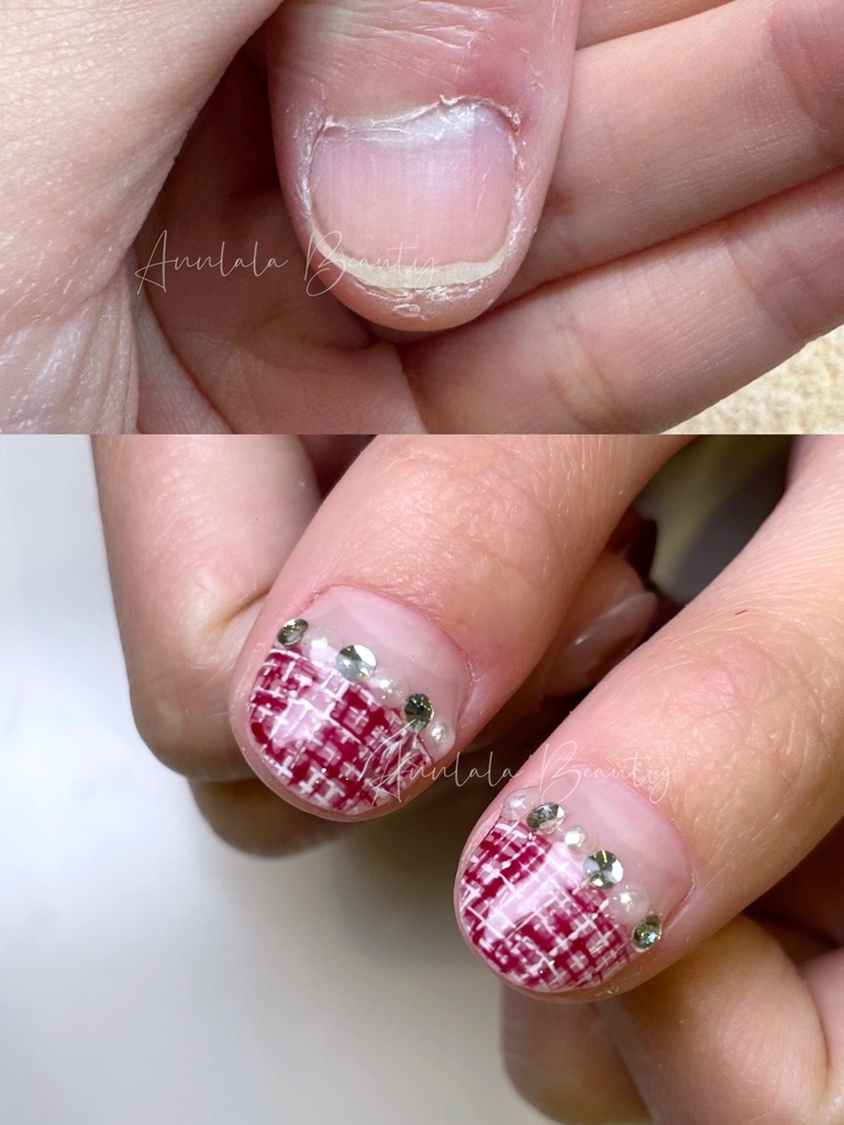 Annlala Beauty 摳 咬甲矯正 (2).jpg